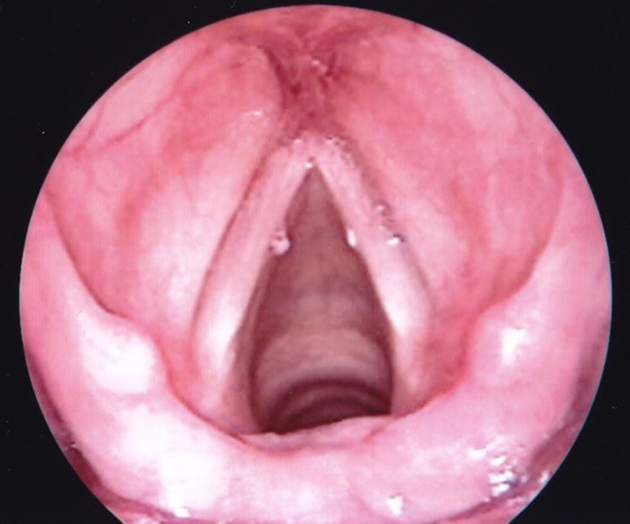 Hình ảnh chụp nội soi hạt xơ dây thanh của người bệnh.