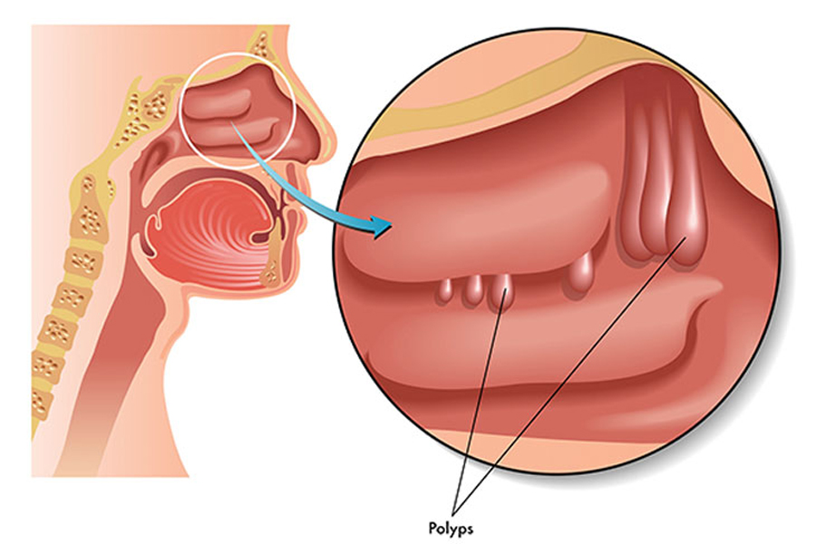 Polyp mũi ở bên trong mũi của một người bệnh.