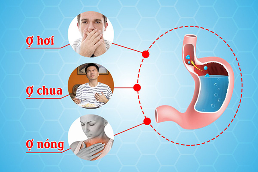 Ợ nóng, ợ hơi, ợ chua là những dấu hiệu thường gặp ở bệnh nhân viêm trào ngược dạ dày.