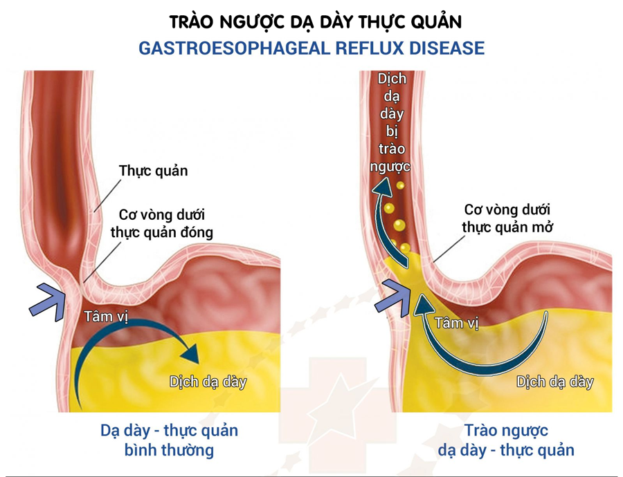 Hiện nay có hơn 7 triệu người Việt Nam mắc bệnh trào ngược dạ dày thực quản, và hơn 1 nửa trong số đó không kịp điều trị dẫn đến biến chứng.