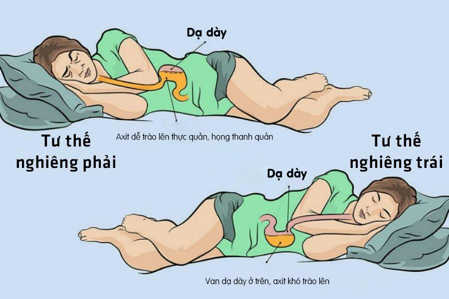 Nếu như nằm nghiêng sang phải khiến nguy cơ tăng dịch vị dạ dày thì nằm nghiêng về bên trái sẽ giúp người bệnh có được giấc ngủ ngon hơn, điều hòa được tình trạng hay bị trào ngược dạ dày.