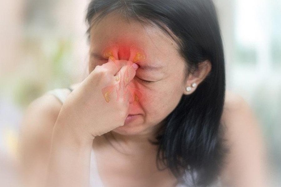 Viêm mũi xoang cấp tính là một dạng nhiễm trùng, viêm nhiễm.