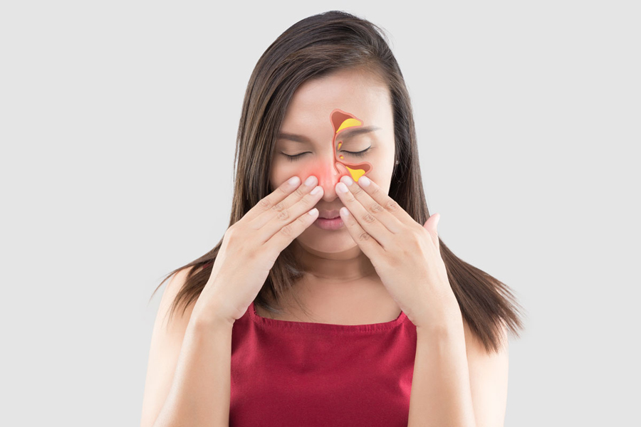 Viêm xoang mũi dị ứng là tình trạng kích thích và viêm mũi niêm mạc mũi.