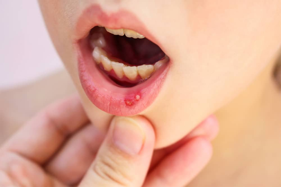 Trẻ bị nhiệt miệng có thể tái đi tái lại nhiều lần gây đau và khó chịu cho trẻ.