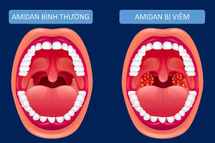 Hạch lympho ở cổ họng bị sưng viêm và chèn lên các cơ quan ở vùng cổ và họng gây nuốt vướng.