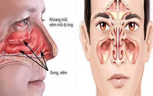 Dị ứng mũi luôn gây cảm giác khó chịu và có thể dẫn tới những biến chứng.