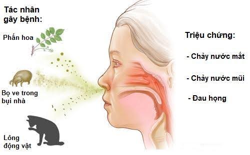 Dị ứng mũi thường kéo theo nhiều triệu chứng gây khó chịu.